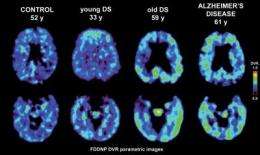 Brain scan identifies patterns of plaques and tangles in adults with Down syndrome 