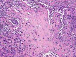 Cancer stem cells recruit normal stem cells to fuel ovarian cancer, U-M study finds 