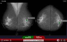 Improving early detection of breast cancer