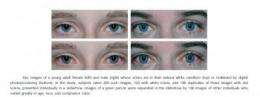 Is beauty found in the whites of the eyes? 'Red eyes' associated with the sad and unattractive