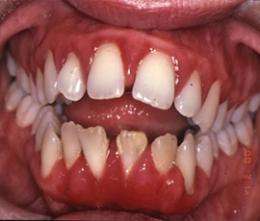 Mouth bacteria provide ideal conditions for gum disease