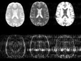 New algorithm could substantially speed up MRI scans