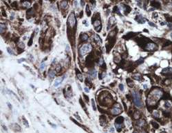 胶质母细胞瘤治疗方法的新见解