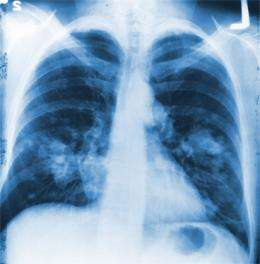 New lung cancer gene found