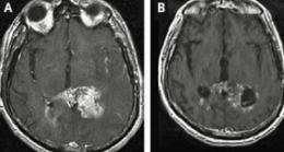 Old drugs find new target for treating brain tumor