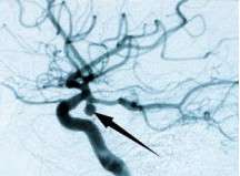 Pipes in the brain as treatment for aneurysms
