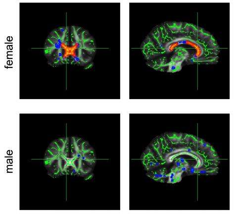 Effects of obesity on the brain: first evidence of sex-related differences