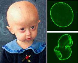 Possible new drug for children with progeria