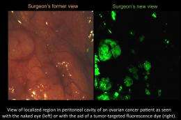 Purdue technology used in first fluorescence-guided ovarian cancer surgery