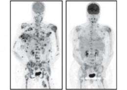 SLAC x-rays help discover new drug against melanoma