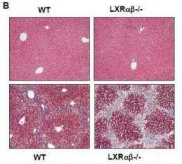 Study finds cholesterol regulator plays key role in development of liver scarring, cirrhosis 