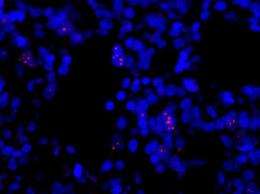 Telomeres: 2 genes linked to why they stretch in cancer cells