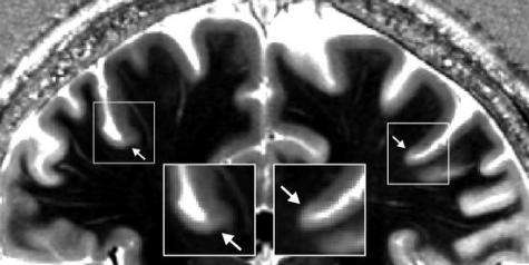 First MR images to show complete borders in human cerebral cortex