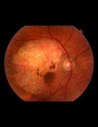 Vision loss in eye disease slowed using novel encapsulated cell therapy