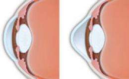 Vitamin B-based treatment for corneal disease may offer some patients a permanent solution