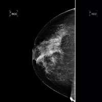 Scientists discover first breast cancer 'oncogene' in five years