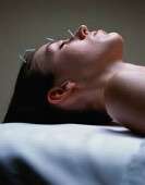 Acupuncture might ease fatigue linked to breast cancer
