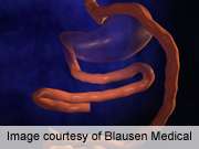 ASMBS: bariatric surgery improves heart disease markers