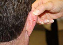 Basal cell carcinoma risk can be chronic