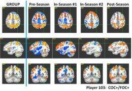 Football findings suggest concussions caused by series of hits