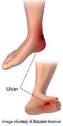 Good long-term limb salvage for diabetic foot patients