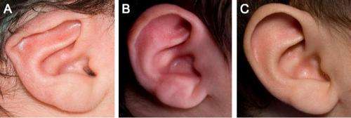 Identification of newborn congenital ear deformities allows for timely, non-surgical correction
