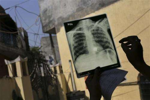 India wages hi-tech war on ancient TB scourge