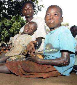 Mysterious nodding disease afflicts young Ugandans