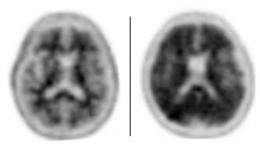 新的成像测试辅助Alzheimer的诊断