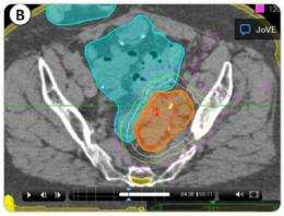New radiation therapy reduces treatment of gynecologic cancers from 5 weeks to 3 days