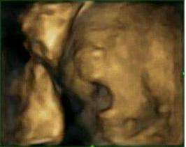Ultrasound pictures show difference in fetus yawning and other mouth openings