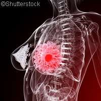 Scientists find link between biological processes and young breast cancer patients