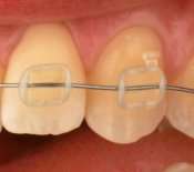 Nanoparticles provide reinforcement for invisible brackets in orthodontics