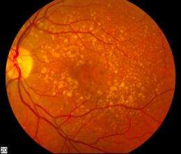 Physics puts new lens on major eye disease