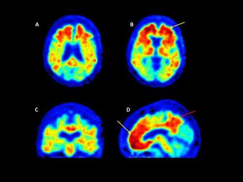The search for the earliest signs of Alzheimer's