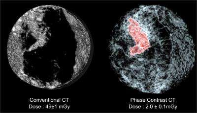Breast cancer scans possible with a 25 times reduced radiation dose