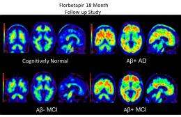 Alzheimer's plaques in PET brain scans identify future cognitive decline