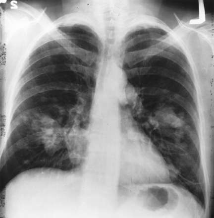 Gene variations linked to lung cancer susceptibility in Asian women
