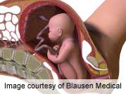 ACOG: delaying cord clamping advised for preterm infants