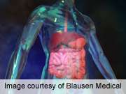 Adjuvant radiochemotherapy has lasting benefit in gastric cancer