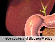 Adjuvant therapy shows promise in biliary tract cancer