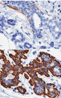 Aging and breast cancer: Researchers uncover cellular basis for age-related breast cancer vulnerability