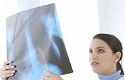 Asymptomatic often sent for lung cancer screening tests