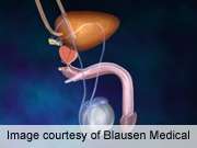 Better analgesia from pelvic plexus block in prostate biopsy