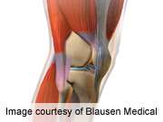 BMI, post-exercise knee laxity change tied to OA progression