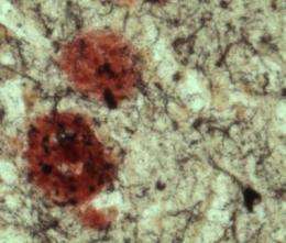 Brain enzyme is double whammy for Alzheimer's disease