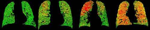 Breathe in, breathe out: New way of imaging lungs could improve COPD diagnosis and treatment