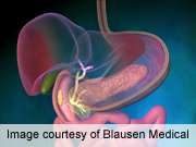 Buspirone improves symptoms in functional dyspepsia