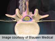 Cell saver not cost-effective in single-level lumbar surgery
