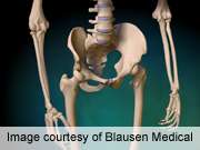 Coexistent lumbar disorders complicate hip arthroplasty
